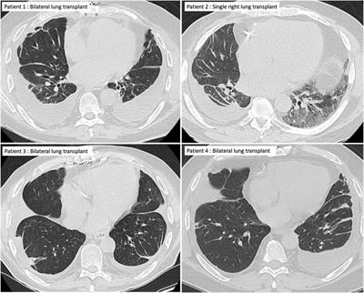 Late-Onset Exudative Pleural Effusions Without Concomitant Airway Obstruction or Lung Parenchymal Abnormalities: A Novel Presentation of Chronic Lung Allograft Dysfunction
